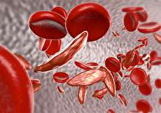 کم خونی داسی شکل چیست و چه علائم و عوارضی دارد؟
