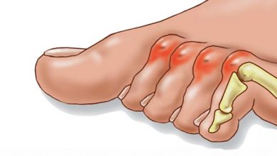 علت و علائم انگشت چکشی پا چیست و چگونه درمان می‌شود؟