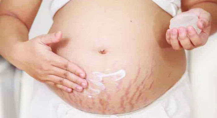 رفع ترک شکم در بارداری با ۲۲ روش خانگی و دارویی