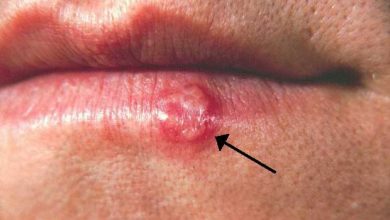 تبخال Herpes-simplex