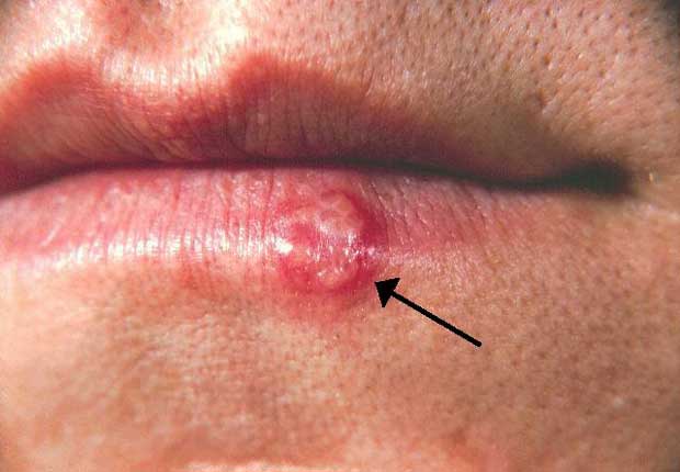 تبخال Herpes-simplex