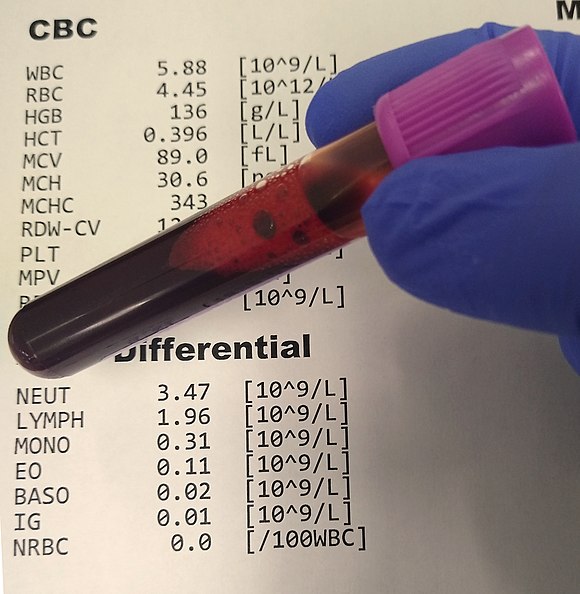 تست شمارش کامل سلول‌های خونی ( CBC )